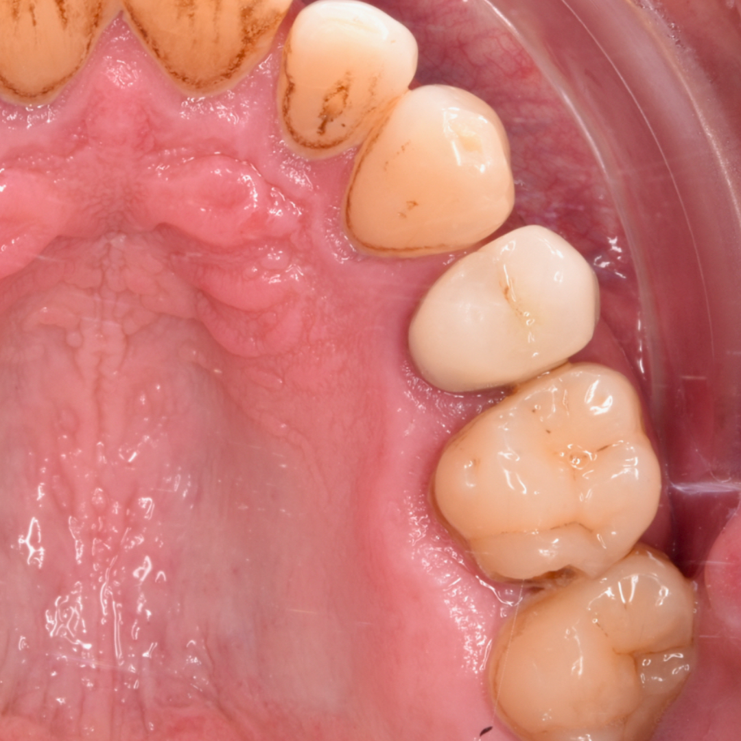 Vue occlusale inférieure