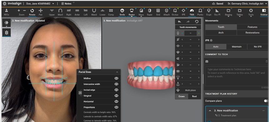 Simulation du sourire avant et après alignement, scénario Invisalign ART