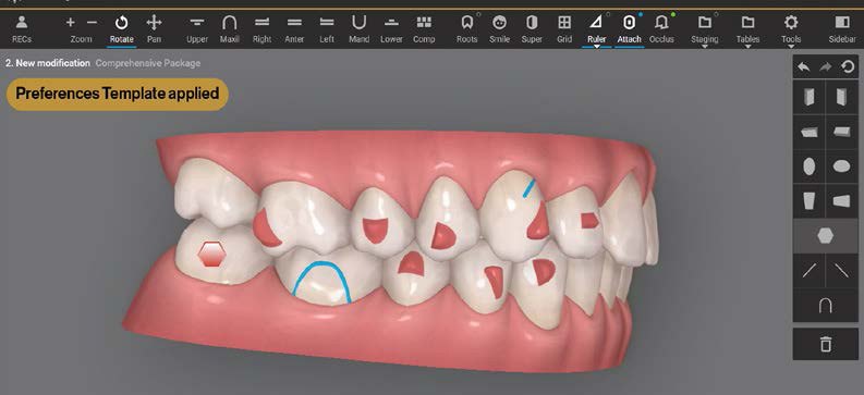 Plan de traitement ClinCheck d'un cas d'orthodontie restaurative